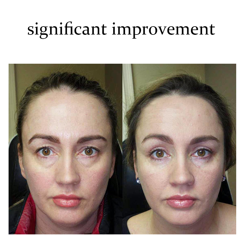 Micro Eye Toner - Improves fine lines and sagging around the eyes